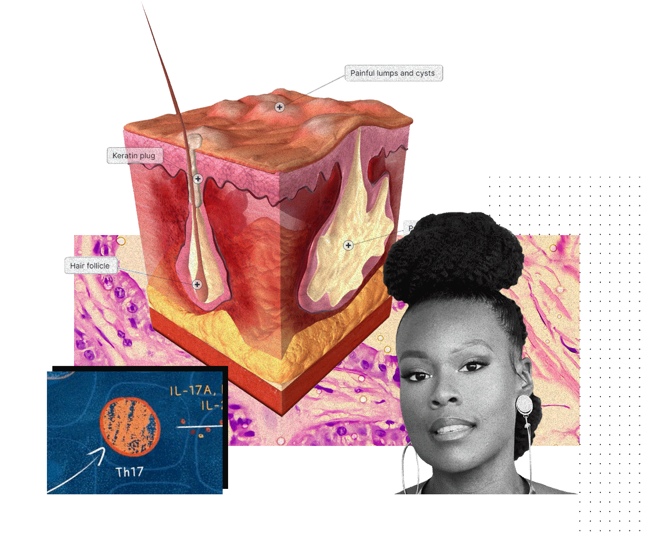 Skin microscopy and 3D illustration of skin layers with follicular inflammation, behind a black woman and a screen depicting Th17.
