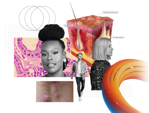 Skin microscopy and 3D illustration of skin layers with follicular inflammation, behind a white man, a black woman and a white woman, skin nodules, and a ribbon.